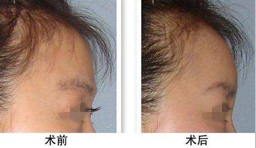 额部整形注意事项有哪些