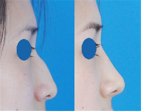 磨驼峰鼻有风险吗