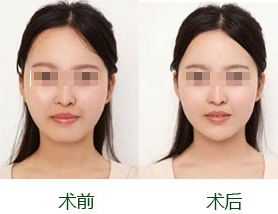 自体脂肪丰下巴特点有哪些