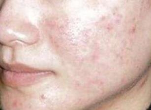 激光祛痘手术效果好吗