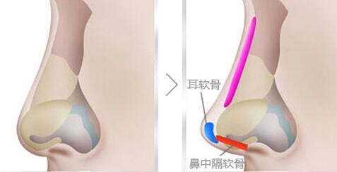自体软骨<a href=http://www.mx185.com/listinfo-737-0.html target=_blank class=infotextkey>隆鼻</a>的手术效果好不好呢