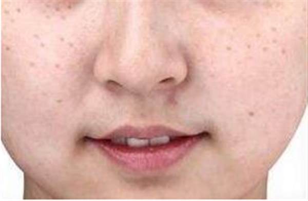 光子<a href=http://www.mx185.com/listinfo-774-0.html target=_blank class=infotextkey>去雀斑</a>有效果吗