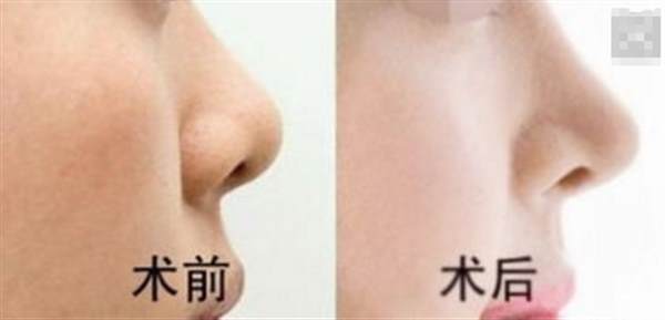 膨体<a href=http://www.mx185.com/listinfo-737-0.html target=_blank class=infotextkey>隆鼻</a>可以长期吗
