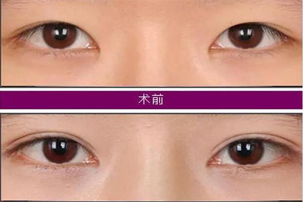 开内眼角图片对比照片