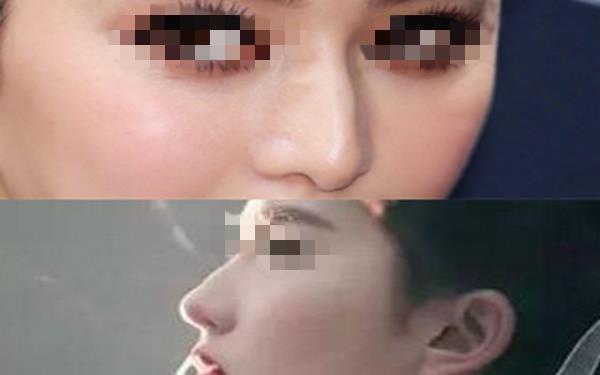 韩式<a href=http://www.mx185.com/listinfo-737-0.html target=_blank class=infotextkey>隆鼻</a>一般多少钱