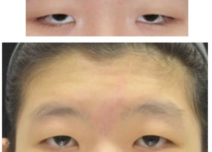 眼睑下垂是原因什么呢