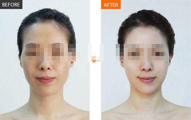 打水光<a href=http://www.mx185.com/listinfo-770-0.html target=_blank class=infotextkey>嫩肤</a>的危害后遗症