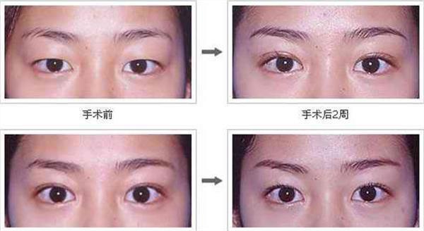 眼部抽脂前后对比