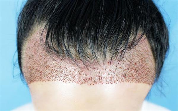 发际线种植费用是多少