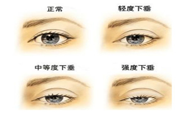 上睑下垂的危害