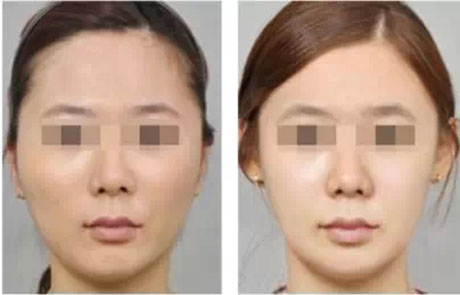 脂肪填充后多久能化妆