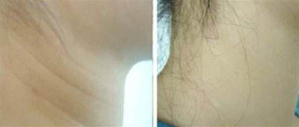 颈纹是怎么形成的