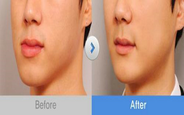 下额角整形多少钱