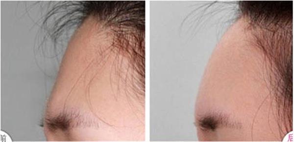 自体脂肪<a href=http://www.mx185.com/listinfo-643-0.html target=_blank class=infotextkey>丰额头</a>有什么注意事项