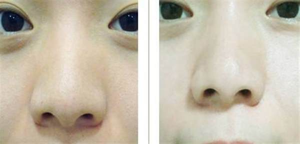 彩光<a href=http://www.mx185.com/listinfo-770-0.html target=_blank class=infotextkey>嫩肤</a>的治疗过程是怎么样的