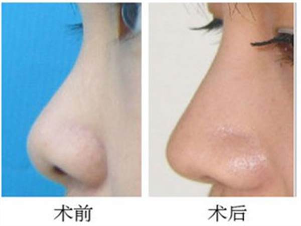 做一个假体鼻子多少钱