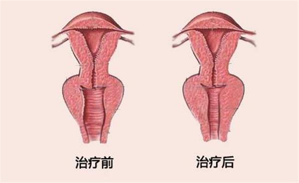 缩阴手术的价格