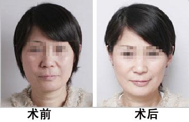 彩光<a href=http://www.mx185.com/listinfo-770-0.html target=_blank class=infotextkey>嫩肤</a>手术有哪些禁忌？