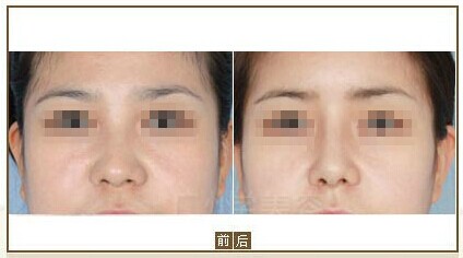 鼻子做完假体多久自然