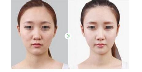 揭秘：彩光<a href=http://www.mx185.com/listinfo-770-0.html target=_blank class=infotextkey>嫩肤</a>的副作用有多少