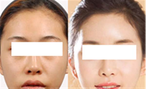 盘点光子<a href=http://www.mx185.com/listinfo-770-0.html target=_blank class=infotextkey>嫩肤</a>的危害性
