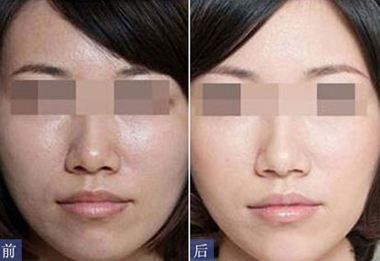 水光嫩肤反黑多久能恢复