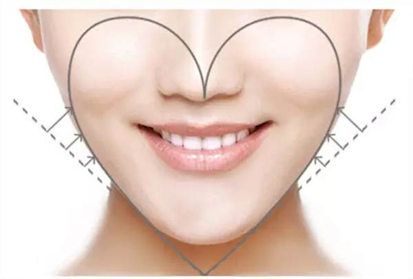 脂肪填充脸多久能消肿