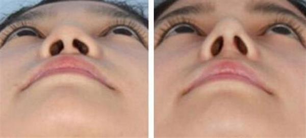 鼻子宽缩小有哪些方法