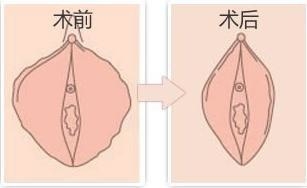 做私密能激光坚持多久