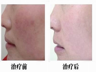 治红血丝多少钱