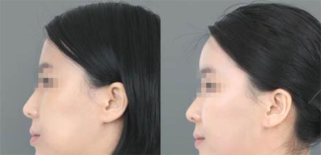 脂肪如何<a href=http://www.mx185.com/listinfo-643-0.html target=_blank class=infotextkey>丰额头</a>