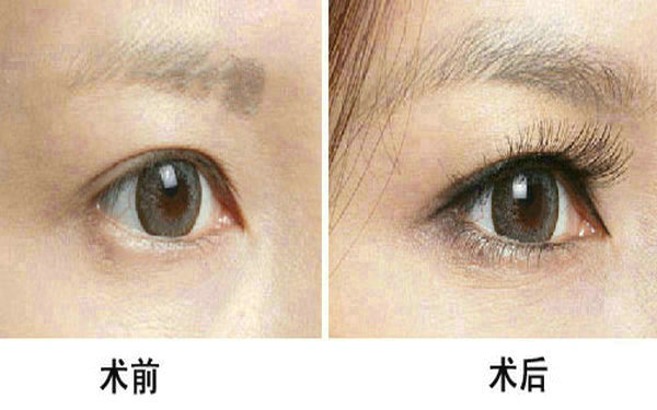 <a href=http://www.mx185.com/listinfo-655-0.html target=_blank class=infotextkey>切眉</a>和提眉哪个效果好?
