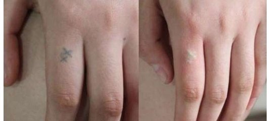 激光去纹身费用