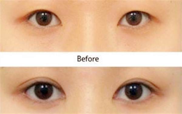 三点<a href=http://www.mx185.com/listinfo-724-0.html target=_blank class=infotextkey>双眼皮</a>恢复过程是多久