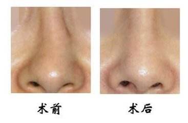 歪鼻鼻型矫正不适合哪些人群