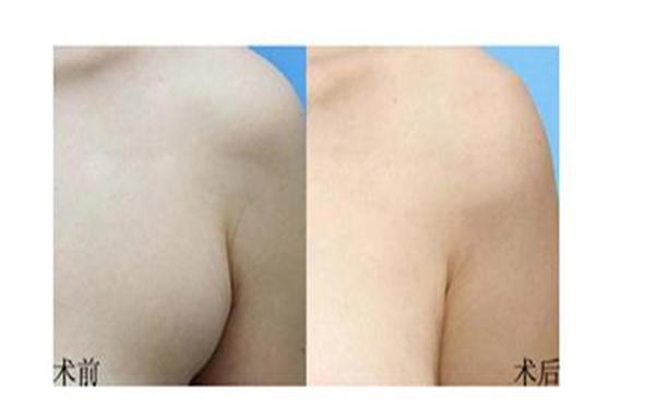 切副乳要多少钱