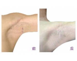 怎么才能治疗狐臭