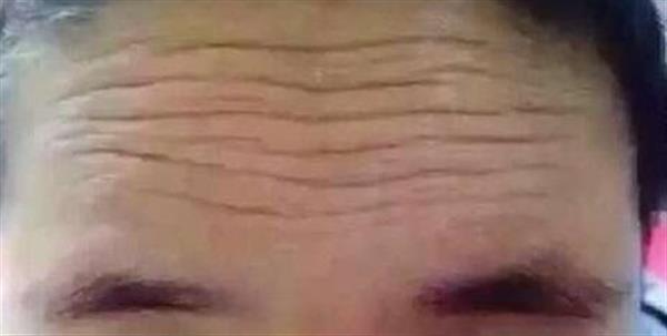青少年怎么去抬头纹