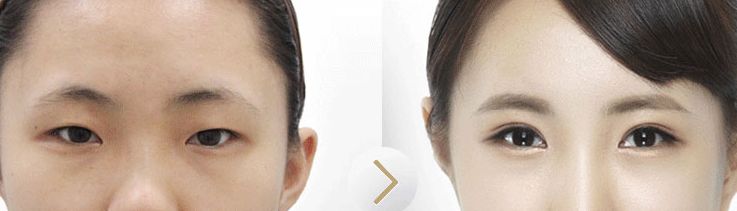 韩式长期<a href=http://www.mx185.com/listinfo-724-0.html target=_blank class=infotextkey>双眼皮</a>价格