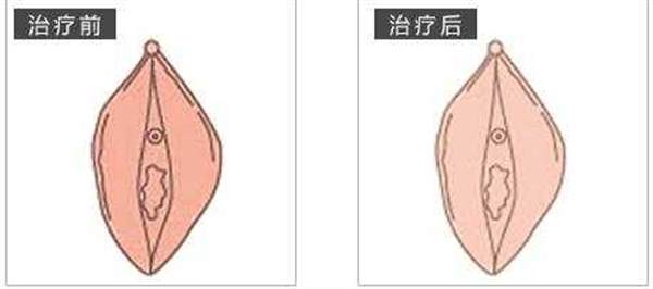 矫正手术大阴唇危险吗
