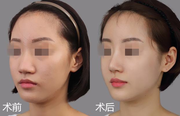 杭州天津做自体软骨<a href=http://www.mx185.com/listinfo-737-0.html target=_blank class=infotextkey>隆鼻</a>要多少钱