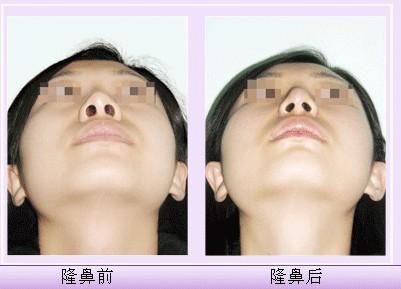 深圳鼻<a href=http://www.mx185.com/listinfo-6-0.html target=_blank class=infotextkey>整形案例</a>