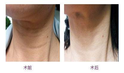怎样去除脖子上的颈纹