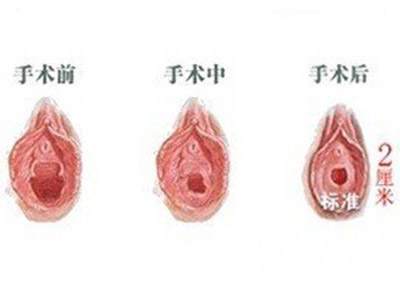 小阴唇手术愈合图片