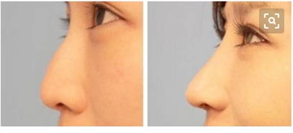 注射<a href=http://www.mx185.com/listinfo-737-0.html target=_blank class=infotextkey>隆鼻</a>效果怎么样呢