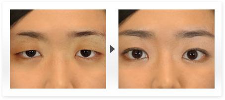 眼睑下垂的原因是什么