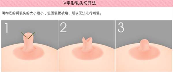 什么是乳头<a href=http://www.mx185.com/listinfo-625-0.html target=_blank class=infotextkey>乳晕缩小</a>术