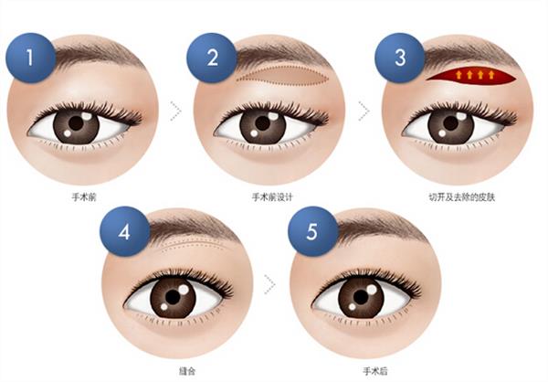 <a href=http://www.mx185.com/listinfo-655-0.html target=_blank class=infotextkey>切眉</a>会留下疤痕吗