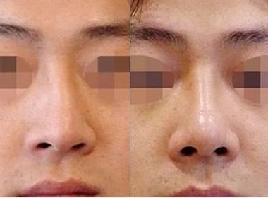 畸形鼻矫正价格