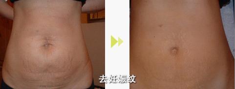 妊娠纹能彻底消除吗
